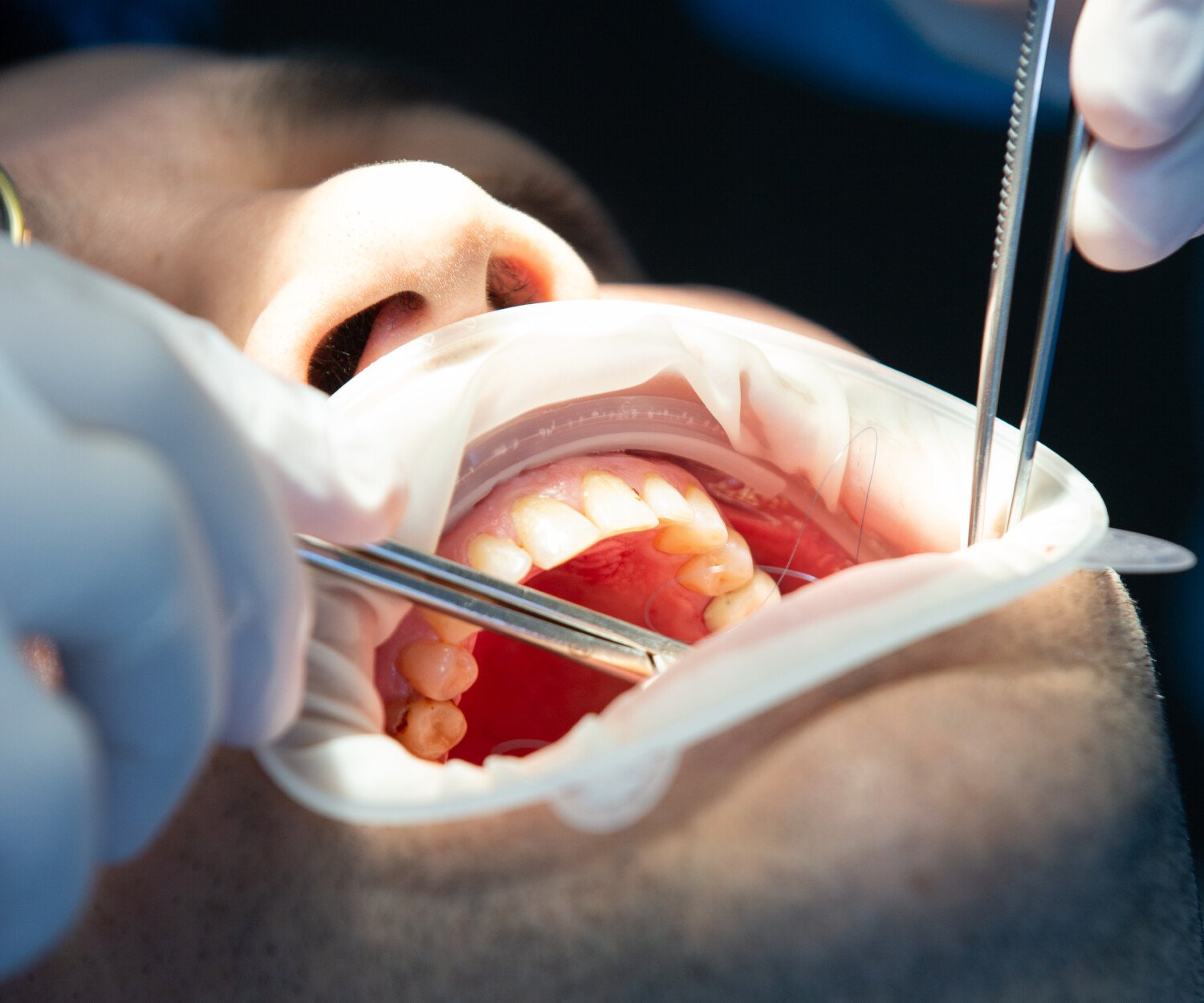 pacient in dental clinic while operation
