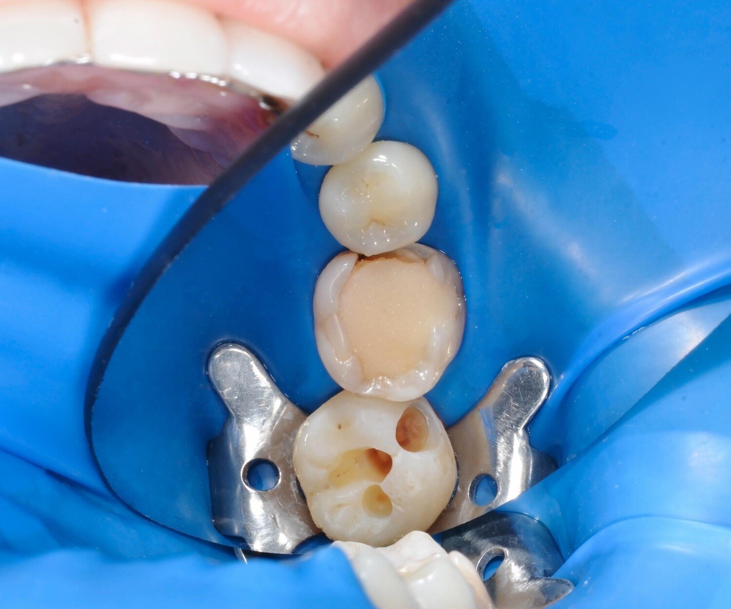 Artistic restoration and restoration of the contact point on the tooth 2.6. Close-up photo in dentist room.