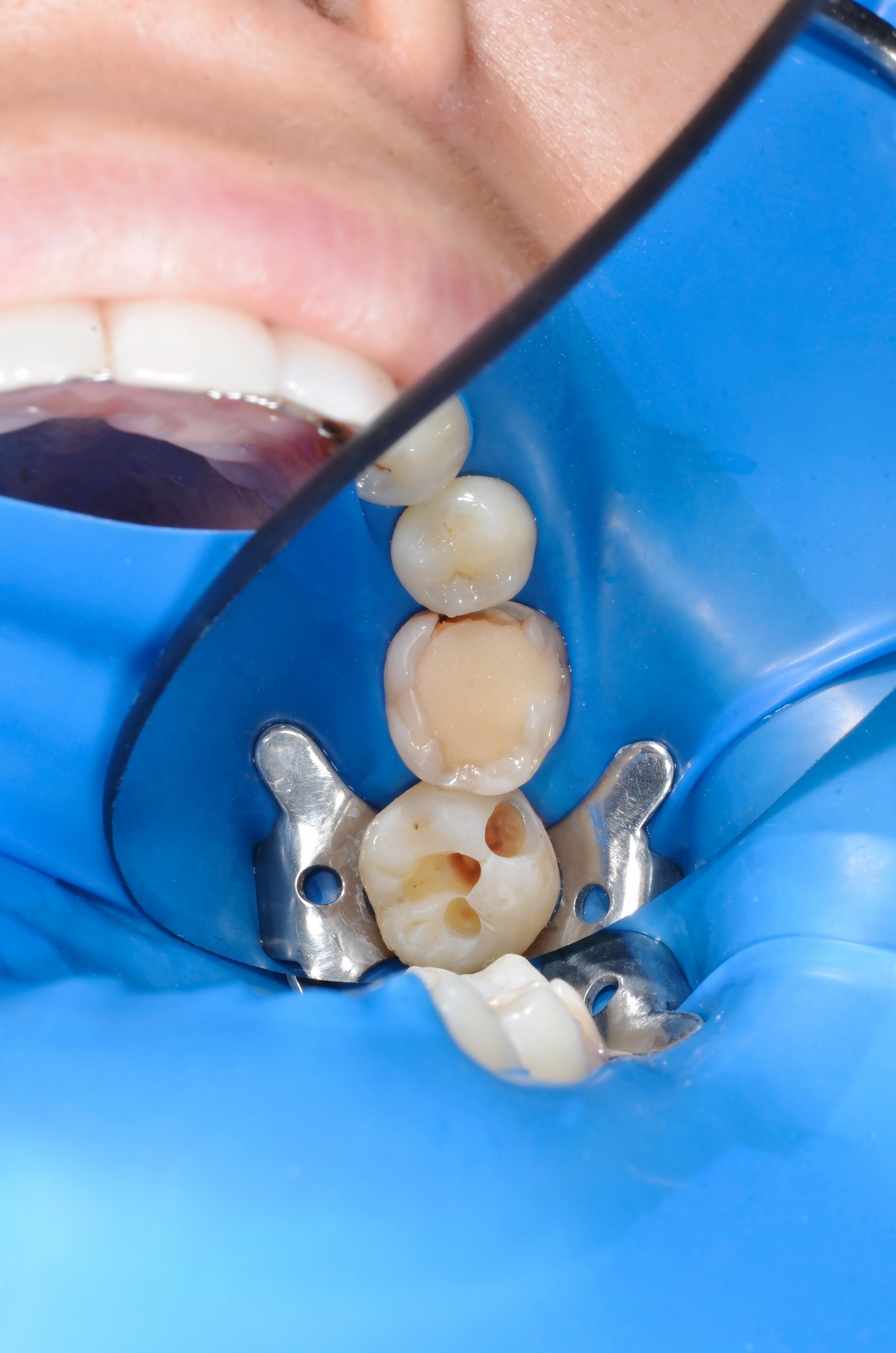 Artistic restoration and restoration of the contact point on the tooth 2.6. Close-up photo in dentist room.
